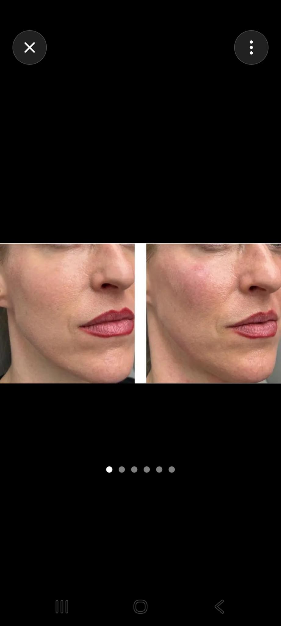 Cheek Filler Before & After